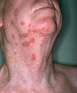 chicken pox vaccination causing shingles epidemic